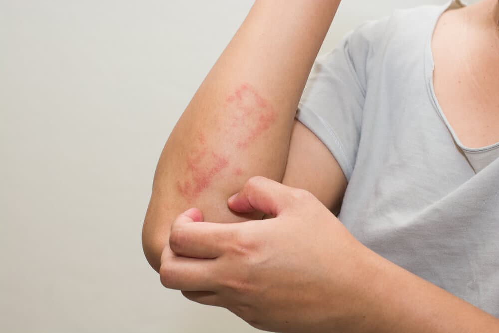 Allergic Reactions