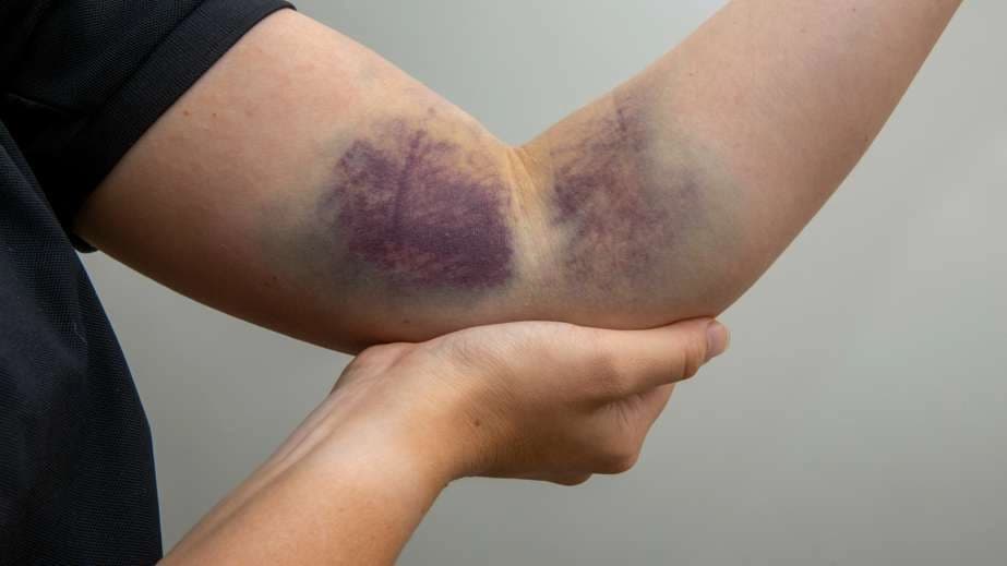 Bruises and Contusions