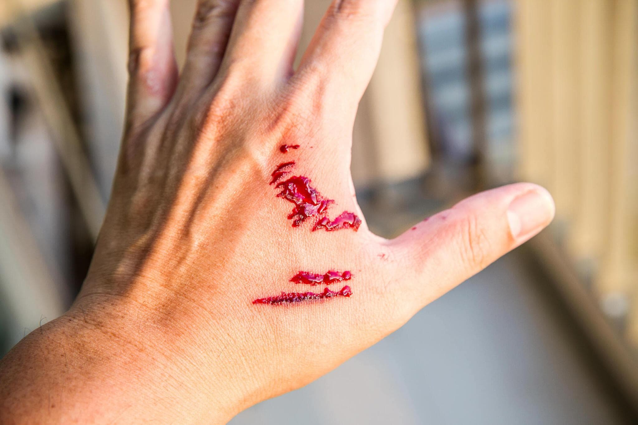 Cuts, Lacerations & Stitches