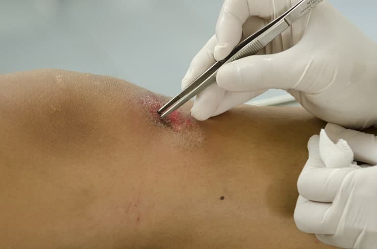 Foreign-Body Removal