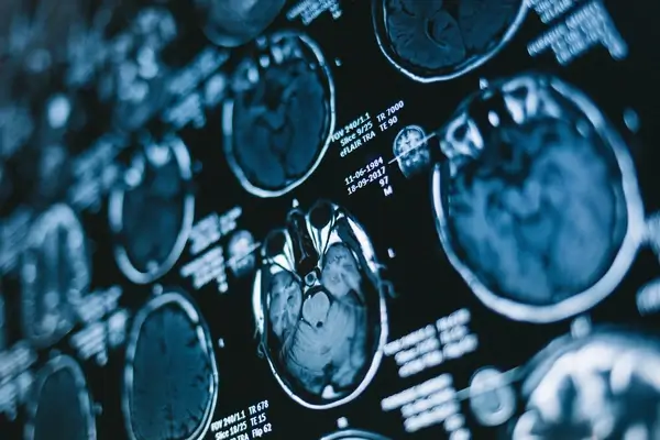 MRI