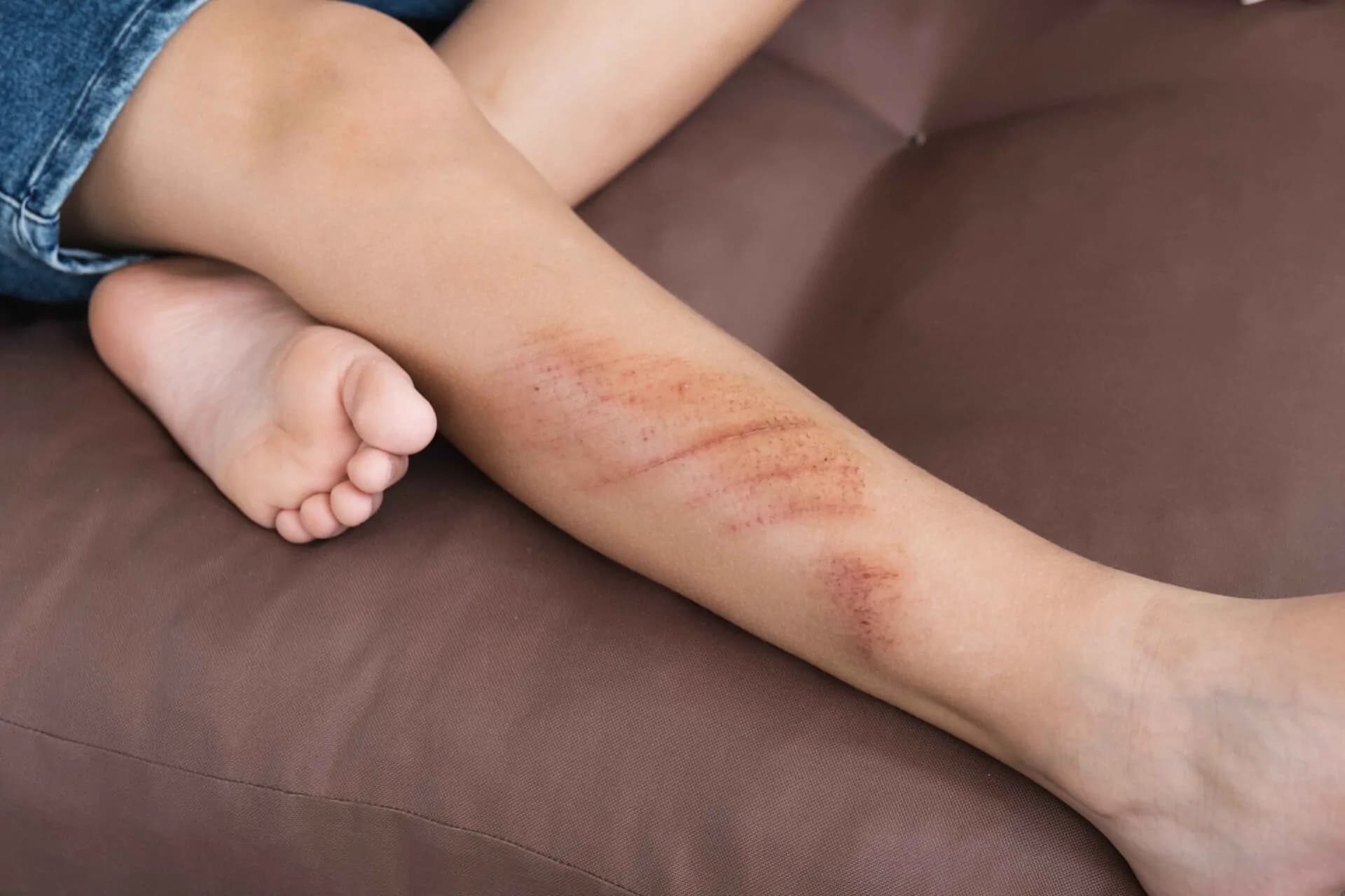 Cuts and Scrapes