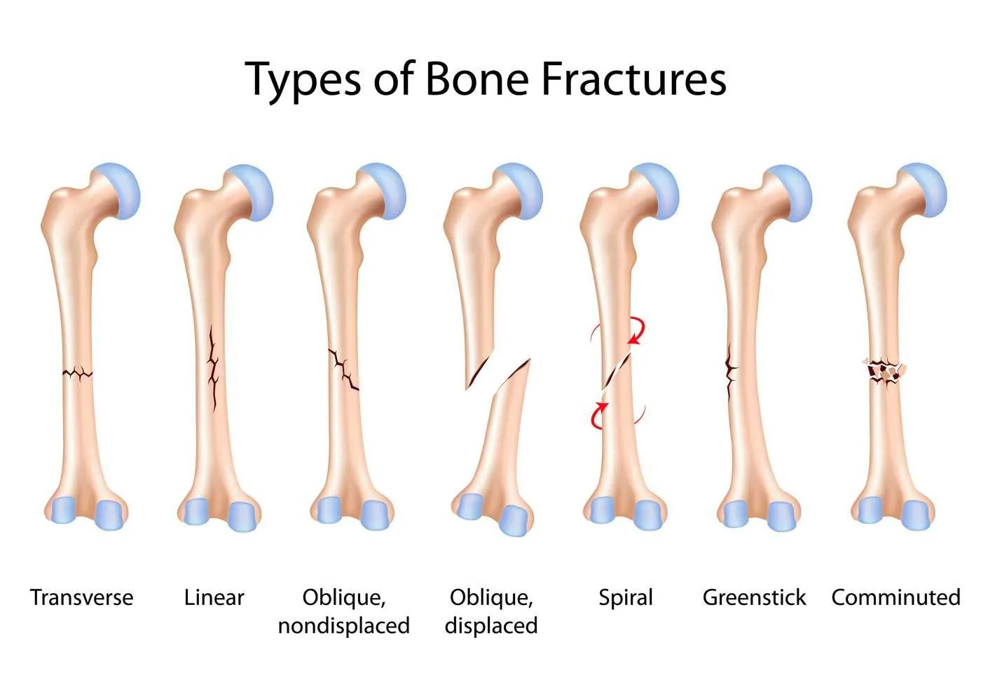 Simple Stress Fractures
