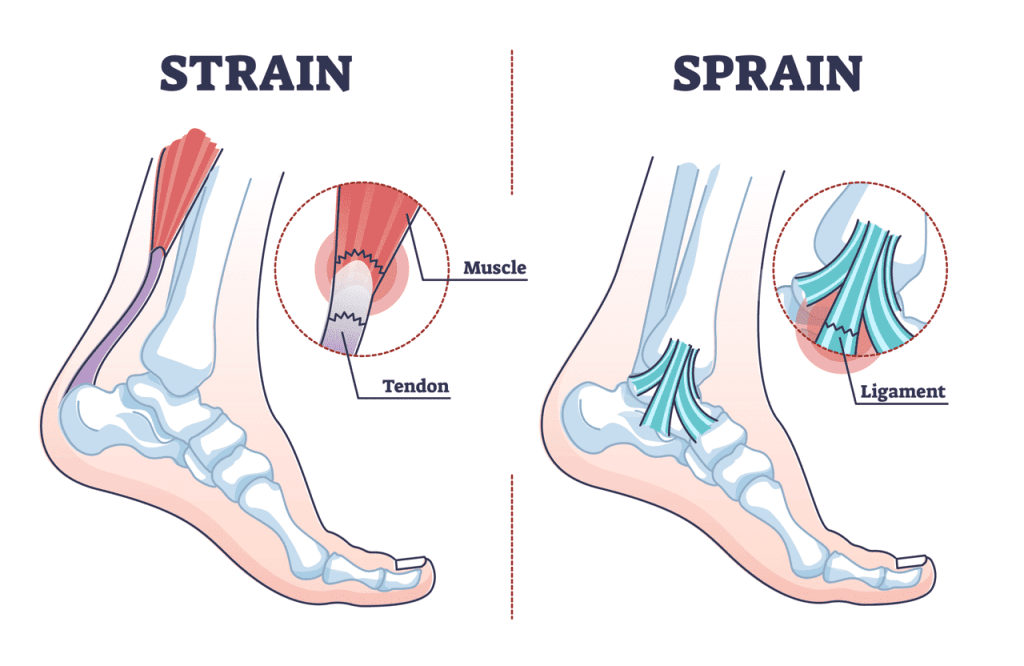 Sprains, Strains & Fractures