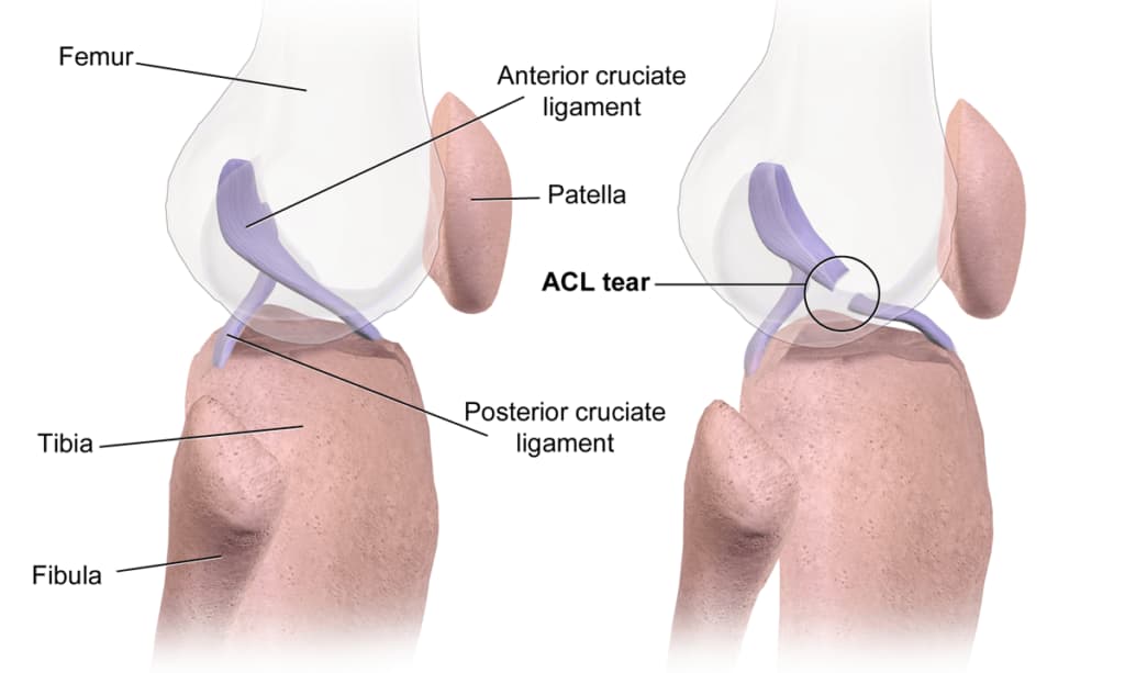 Tendon & Ligament Tears (ACL, MCL, Achilles)